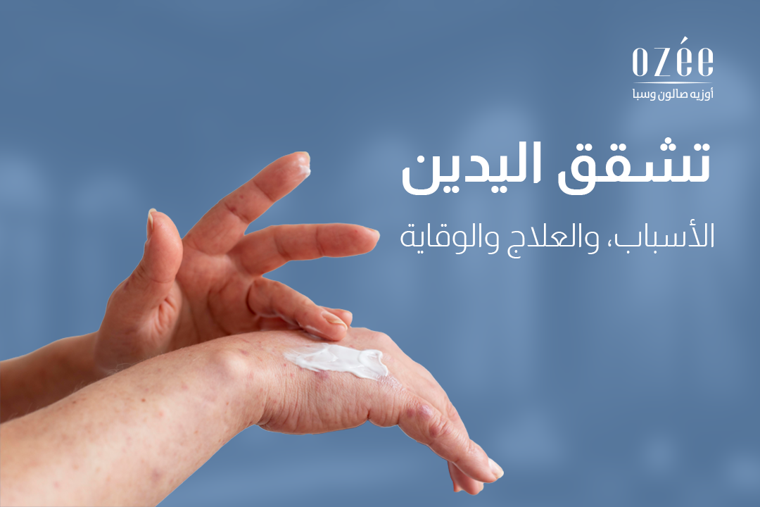 تشقق اليدين: الأسباب، والعلاج والوقاية