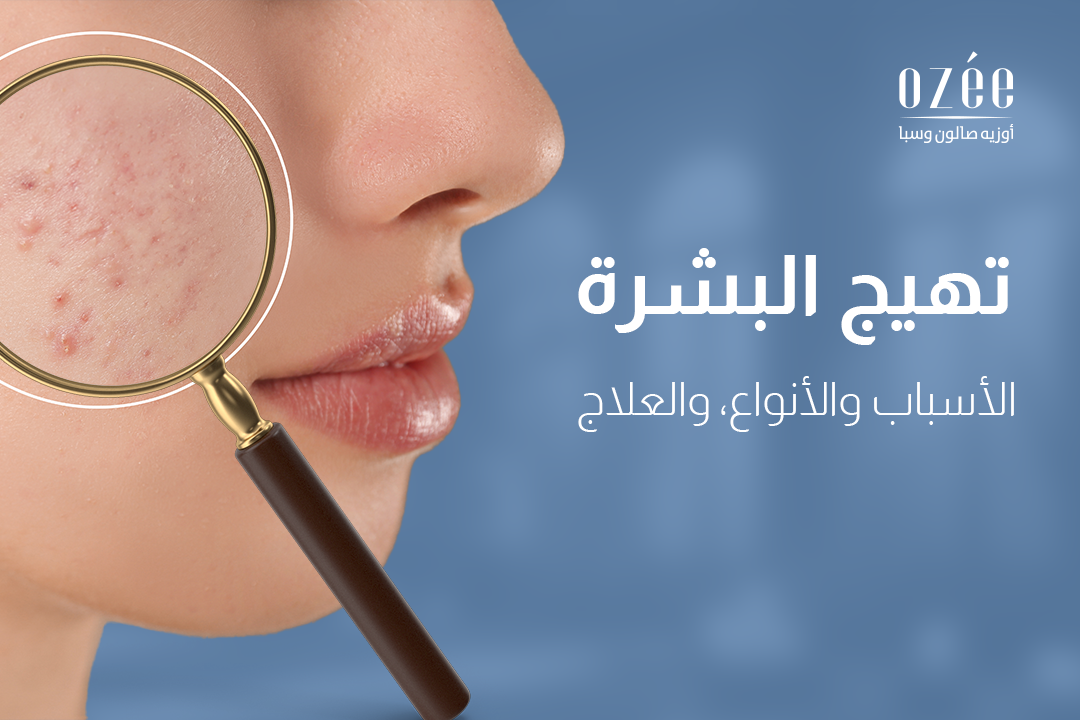 تهيج البشرة: الأسباب والأنواع، والعلاج