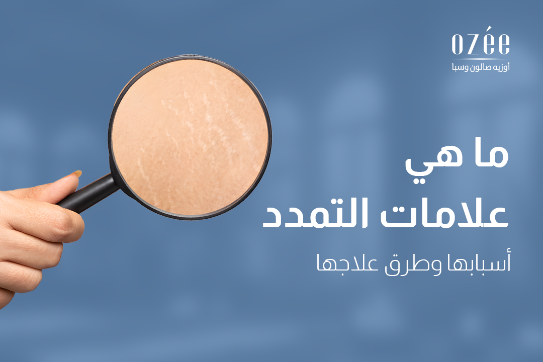 ما هي علامات التمدد: أسبابها وطرق علاجها