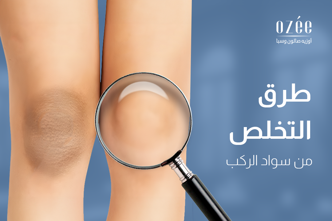 طرق التخلص من سواد الركب